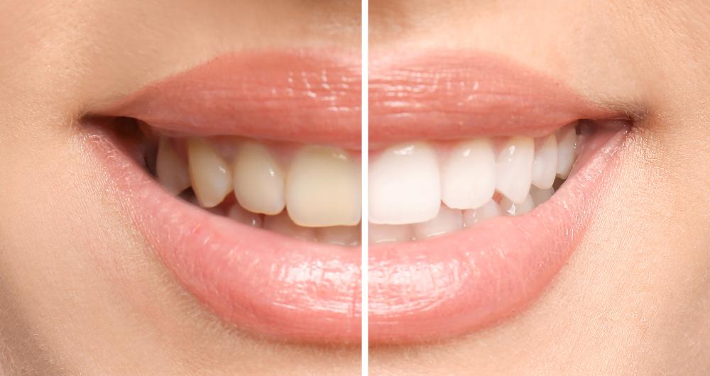 Teeth Whitening Example | Warners Bay Dentist