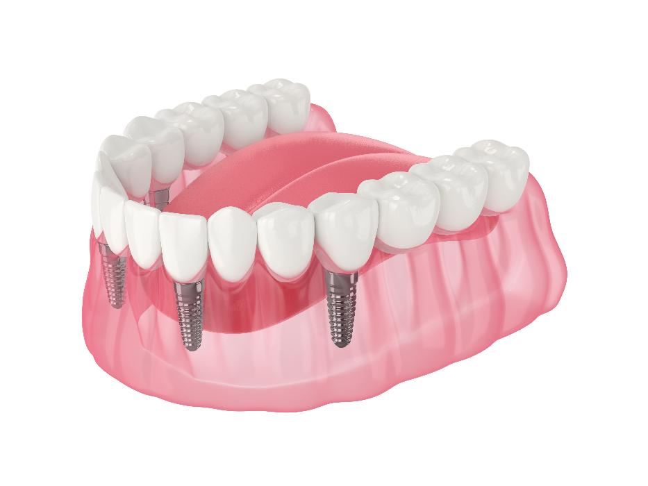 diagram of dental implants in warners bay