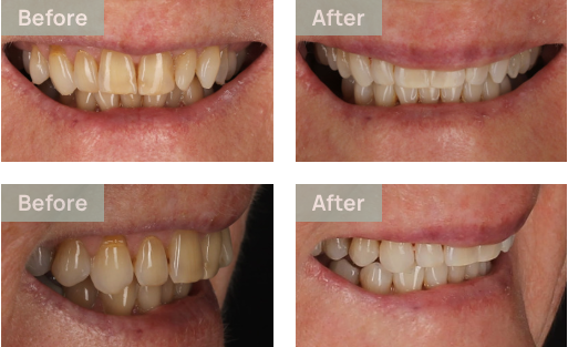 before and after photos of our invisalign patients