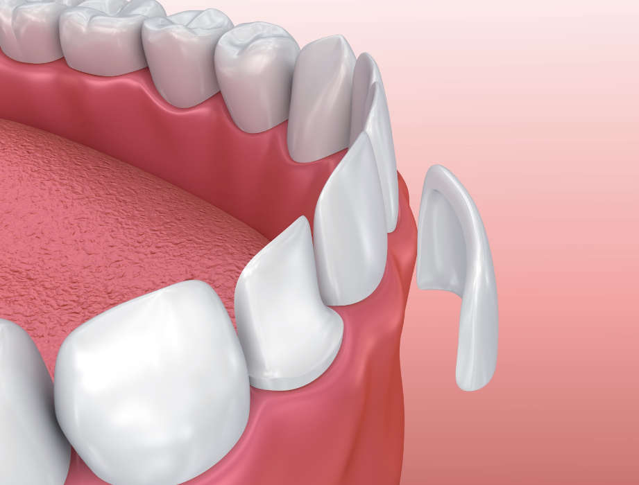 Veneers Diagram | Warners Bay Dentist