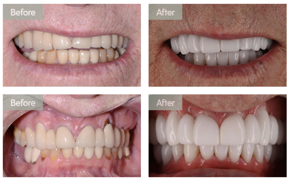 before and after photos from a smile makeover
