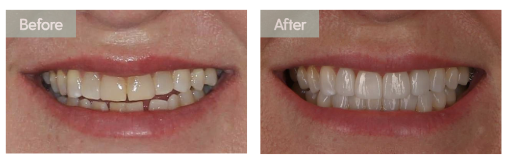 before and after images of smile makeover