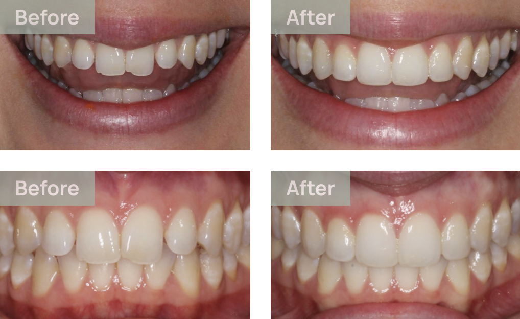 invisalign before and afters