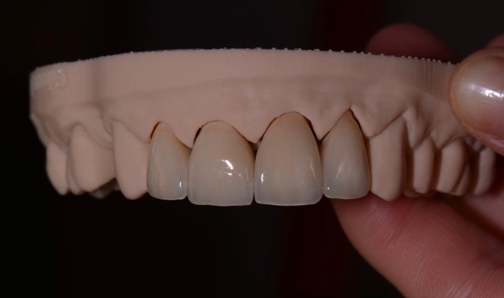 Dental Crowns made in Warners Bay