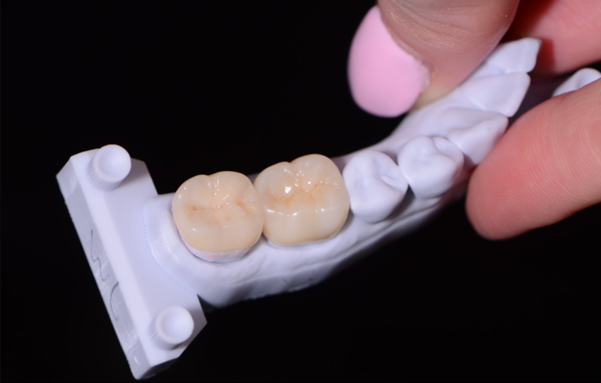 dental crowns in warners bay