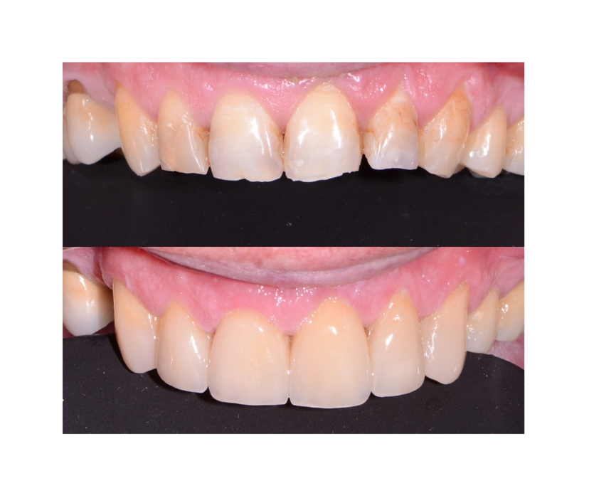 Before & After of Dental Bridge