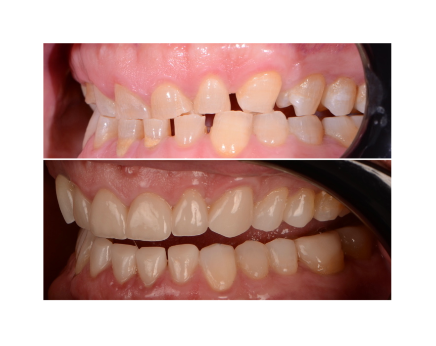 full mouth rehabilitation before and after in warners bay