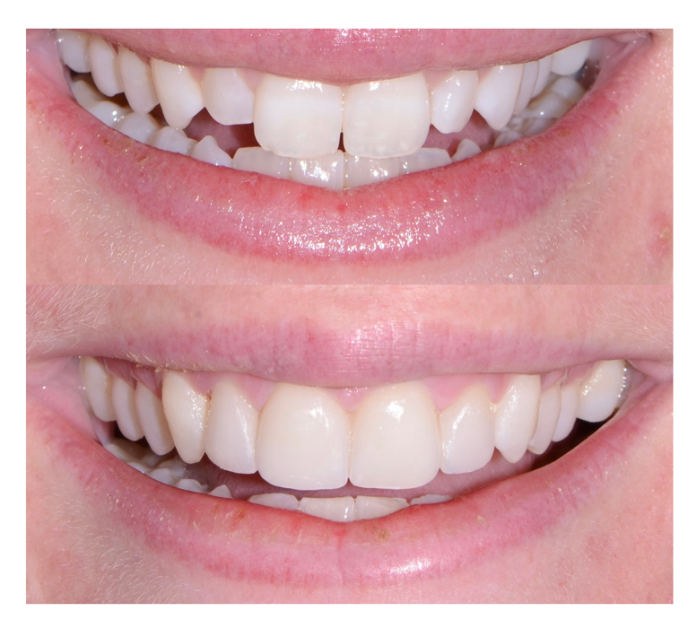 Before & After Veneers at SmilesHQ