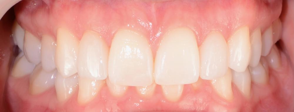 smile after cosmetic dentistry 