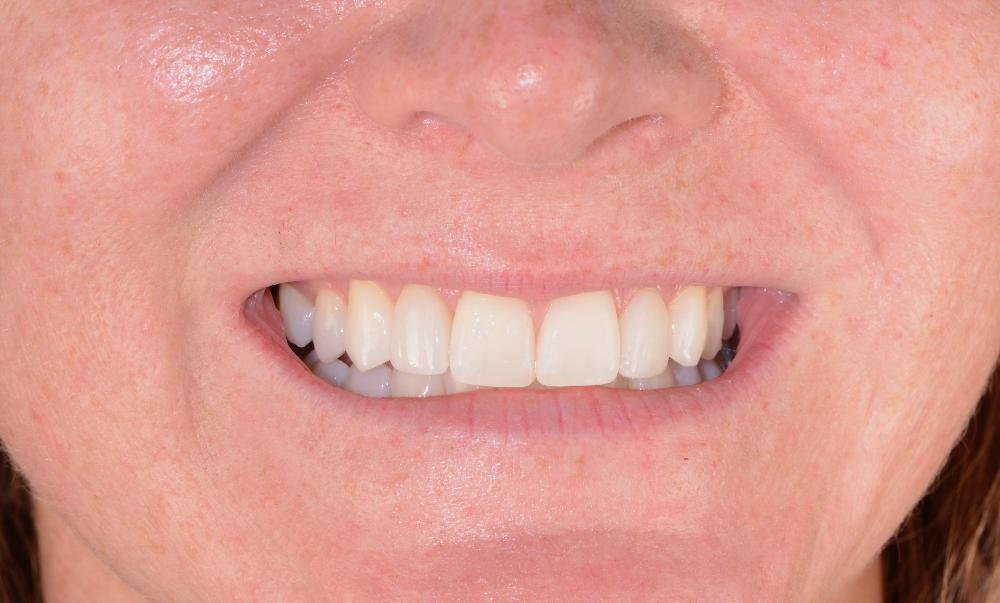 close up of patient's smile after cosmetic dentistry