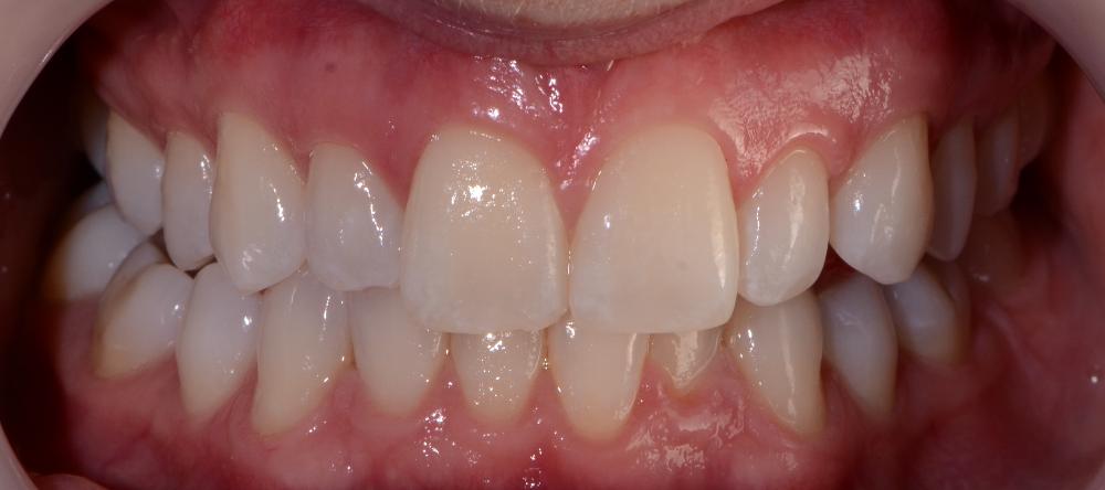 smile before cosmetic dentistry