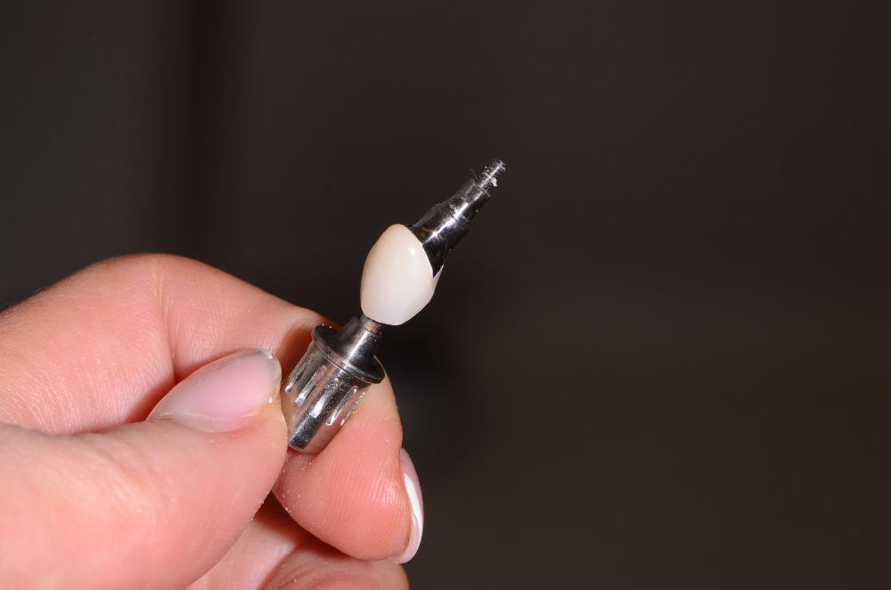 a dental implant made in warners bay