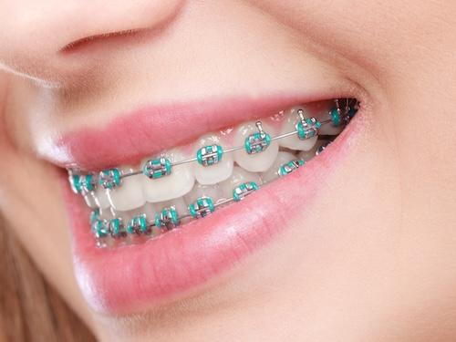 close up of patient's smile with braces