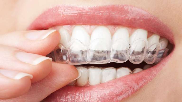 close up of woman using clear aligners 