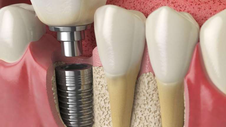 dental implant 