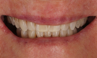 After treatment - Clear Aligners Transformation with Teeth Whitening