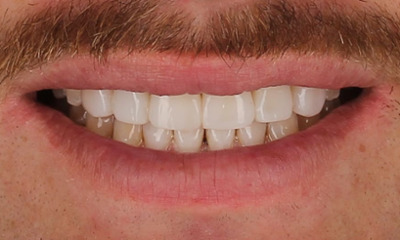 After treatment - Clear Aligners, with Composite Veneers