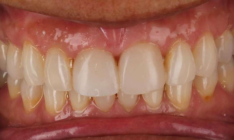 smile after teeth whitening and composite bonding