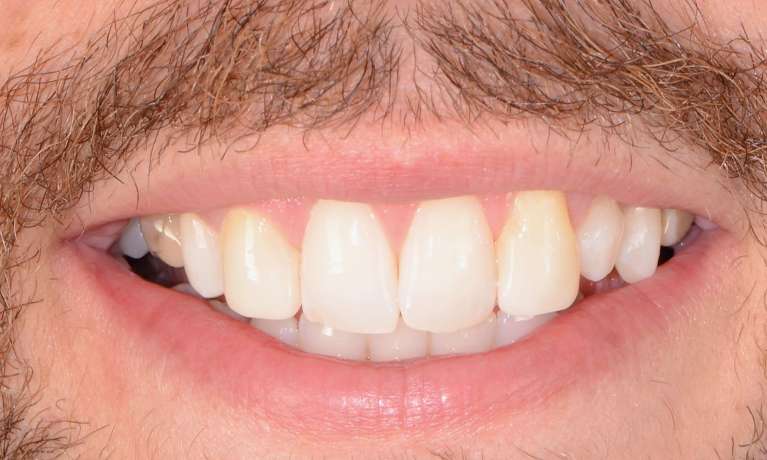 new smile after whitening and composite bonding