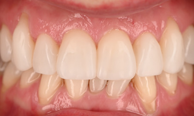 smile after whitening and veneers