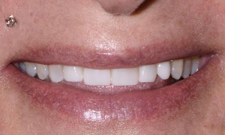 Composite Veneers Warners Bay After