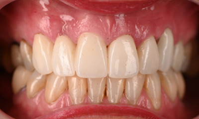 post crowns and bridges
