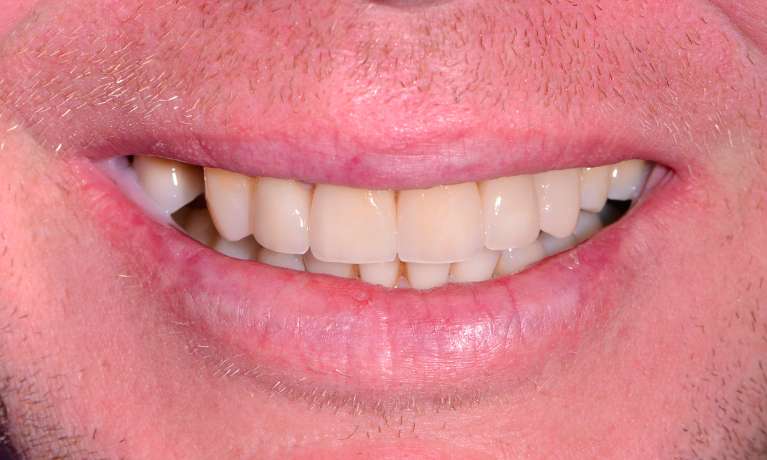 patient with new crowns and veneers in warners bay