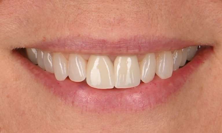 smile after teeth whitening and dental crowns