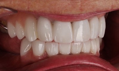 After treatment - Dental Crowns Replacement and Partial Dentures