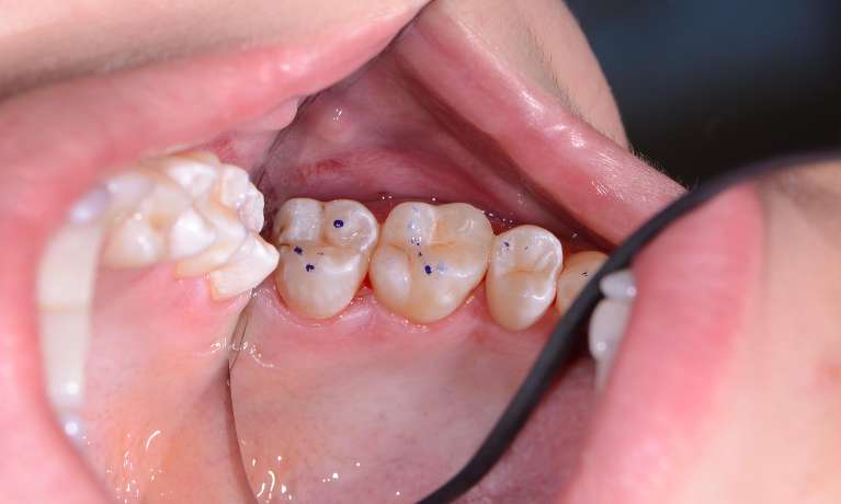 Dental-Fillings-on-Back-Tooth-After-Image