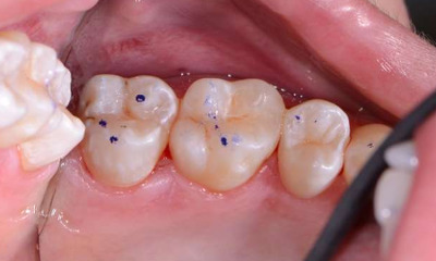 Dental-Fillings-on-Back-Tooth-After-Image