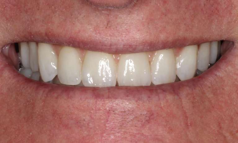 Full-Arch-Dental-Implant-After-Image