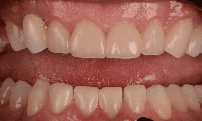 patient with brand new smile in warners bay