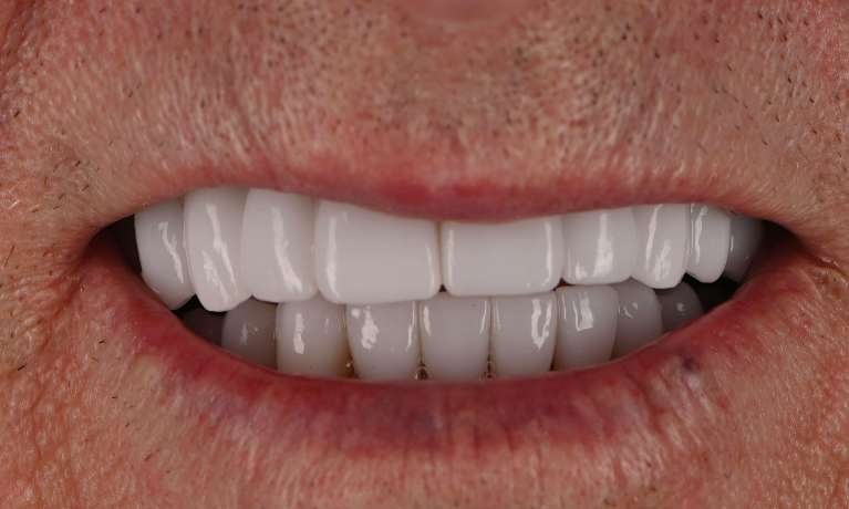 Full-Mouth-Rehabilitation-After-Image