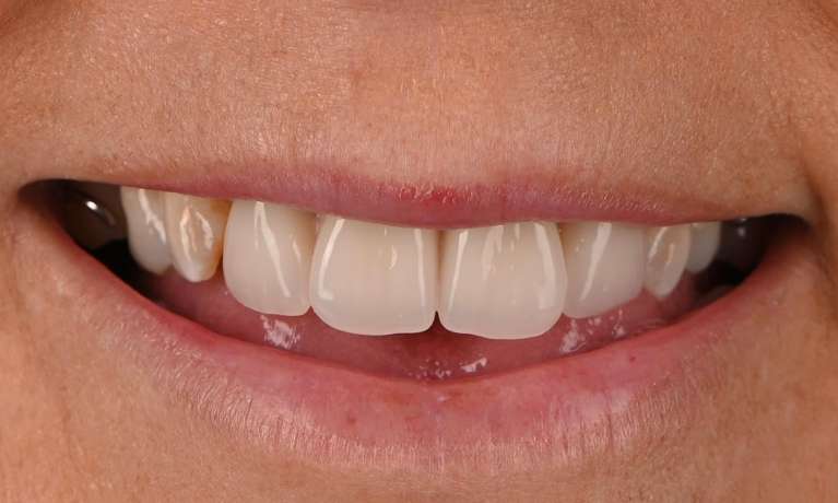 Full-Smile-Rehabilitation-After-Image