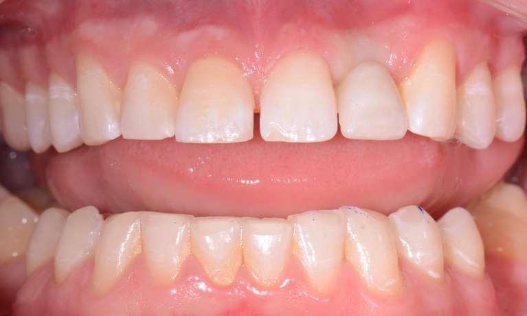 smile after dental implant for front tooth