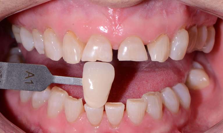 bright smile after teeth whitening