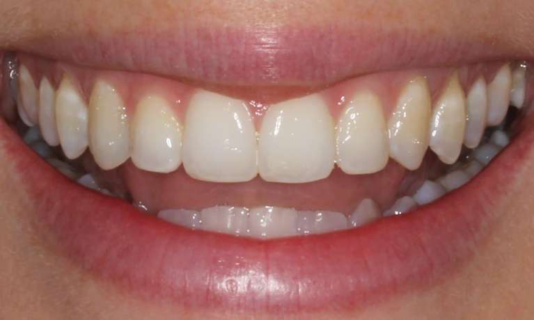 bright, straight smile after invisalign treatment and bonding