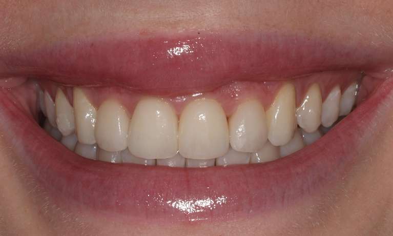 Smile after clear aligners 