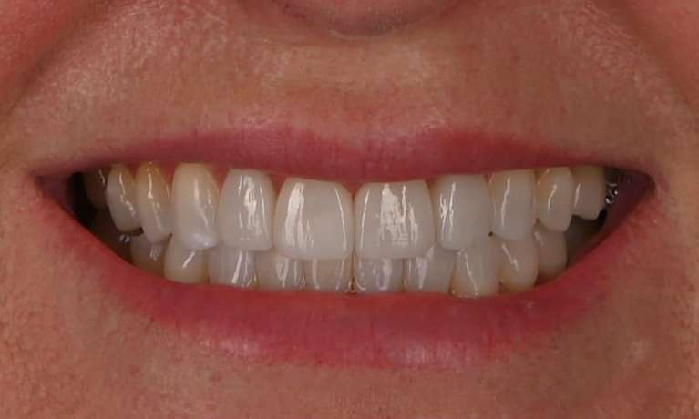 new bright results after Invisalign and veneers