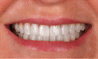 Invisalign-Porcelain-Veneers-and-Teeth-Whitening-After-Image