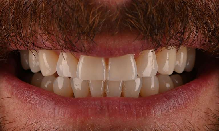 Invisalign-Teeth-Whitening-and-Composite-Bonding-After-Image