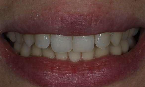 patient's smile after invisalign treatment