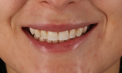 After treatment - Invisalign®