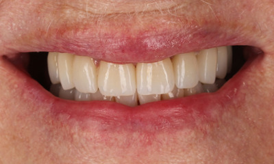 After treatment - Porcelain Crowns and Bridges Transformation