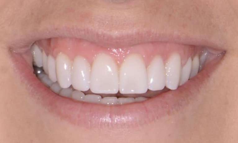 bright front teeth after dental veneers