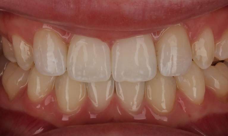 close up of smile after veneers and orthodontics