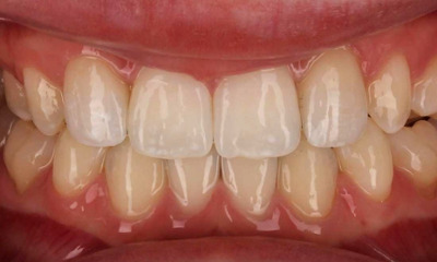 close up of smile after veneers and orthodontics