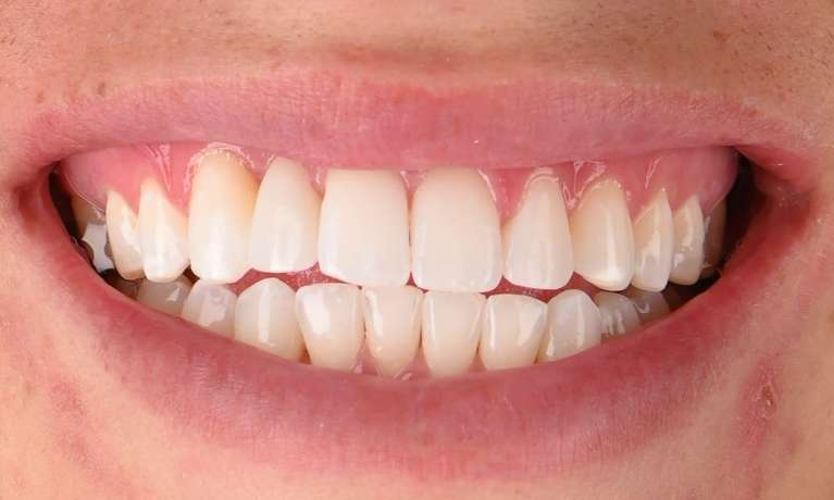 Post Ortho Whitening Veneers After 1