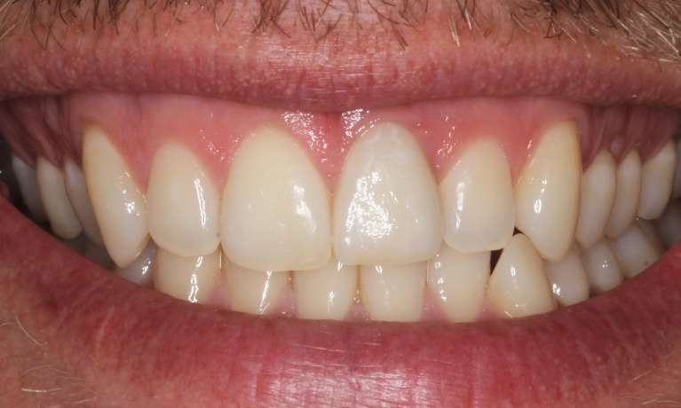 after single dental implant restored patient's smile